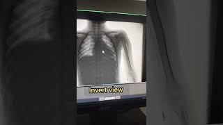 Xray Pick line  Xray Procedure radiography xray anatomy babyshorts trending viralviewsct [upl. by Ettelohcin]