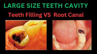 TREATMENT OF LARGE TOOTH CAVITY  DECISION MAKING OF LARGE TOOTH DECAY WITH TOOTH FILLING VS RCT [upl. by Stanley355]