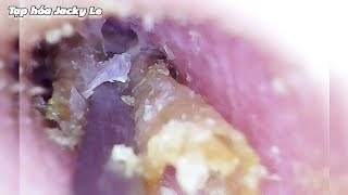 Ear Wax Removal 112 Unbearable Itching Due To Yeast Infection In Earwax  Ear Cleaning ASMR [upl. by Aseram]