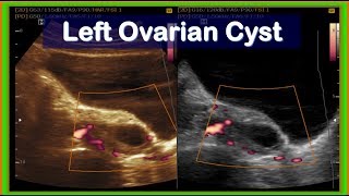 Ultrasound cases 306 of 2000  Practical Ultrasonography Left Ovarian Cyst [upl. by Rasia238]