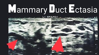 Mammary Duct Ectasia [upl. by Nojad]