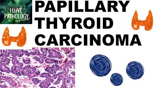 PAPILLARY THYROID CARCINOMA  Gross and Microscopic features [upl. by Anivek]