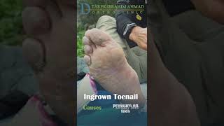 what is an impacted nail   ingrown toenail [upl. by Kylen]