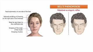 Bells Palsy [upl. by Bently]