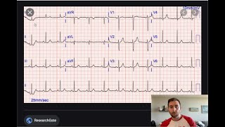 EKG 101  quotRhythmquot  Part 37 [upl. by Dodi]