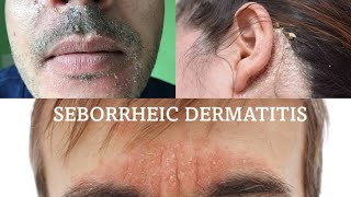 Seborrheic dermatitis  treatment health [upl. by Anauqcaj]