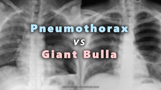 Pneumothorax vs Giant Bulla in Chest X Ray Part 6 [upl. by Marciano328]