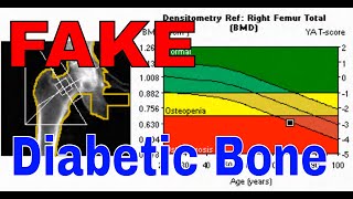 Discovering The Shocking Paradox Of Diabetic Bone Marrow [upl. by Cleve]