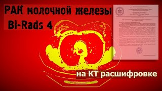 BiRads 4 молочной железы на РАСШИФРОВКЕ КТ грудной клетки РАК МОЛОЧНЫХ ЖЕЛЕЗ у женщин [upl. by Hessler576]