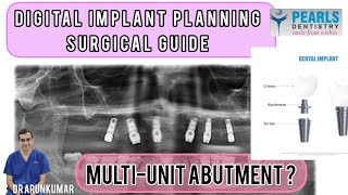 Digital implant planning  Surgical guide  multiunit abutment  Dr Arunkumar  Pearls Dentistry [upl. by Shaum]