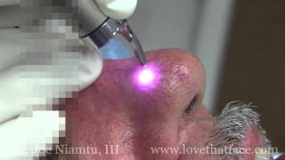 Laser Facial Spider Vein Treatment with Demonstrated by Dr Joe Niamtu III [upl. by Inamik236]