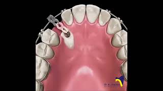 Canine Impaction dentistbracing orthodonticscanineimpactionImpactionExposureCanineexposure [upl. by Accever]