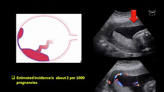 Ultrasound Imaging of the placenta Part 1 Anatomy and Variants [upl. by Sheelagh]