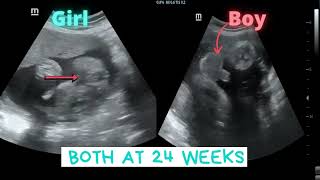 Ultrasound showing Girl Boy both at 24 weeks [upl. by Willabella94]