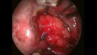 BUCCAL PAD OF FAT after Submucous fibrosis release [upl. by Yovonnda]