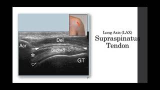 MSK Ultrasound Evaluation Differentiation of Tendinopathy vs Tear in the Rotator Cuff [upl. by Aseeral]