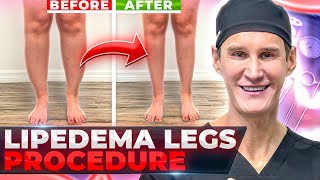 Abnormal FAT deposits Expert tips about LIPEDEMA [upl. by Phebe400]