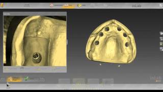 inLab SW 15 ScrewRetained MultiUnit Bridge Workflow [upl. by Merridie]