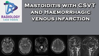 Mastoiditis with CSVT and Haemorrhagic venous infarction [upl. by Kai]