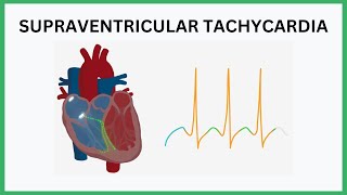 Supraventricular Tachycardia SVT Visualised [upl. by Morlee]