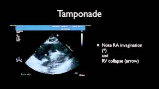 Tamponade amp Pericardiocentesis [upl. by Arin430]