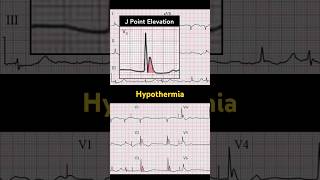 Hypothermia ECG J point elevation [upl. by Leake860]