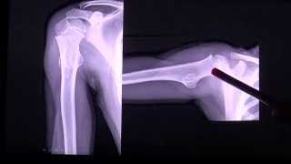 Osteochondroma or osteocartilaginous exostosis tumor in CT scan by RadiologyTV [upl. by Chiou]