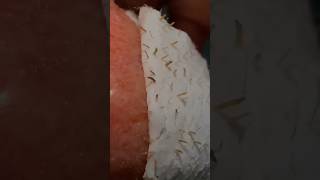 Get Rid of Blackheads ampWhiteheads Remove Blackheads easily at home in 1 day shorts viralshorts [upl. by Hannahc]