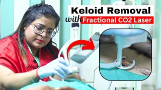 how to remove keloid  Keloid Removal with Fractional CO2 Laser at atomic clinic DrSnehaGuptaMD [upl. by Kitarp]