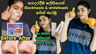 අඩු මුදලකින් ගෙදරදීම White heads amp Black heads අයින් කරගමු 😍  රන්වන් සමක් දෙන 24K Gold Serum 🥰 [upl. by Atirahs494]