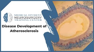 Disease Development of Atherosclerosis [upl. by Hallagan]