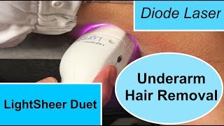 The LightSheer Duet Diode Laser for Underarm Hair Removal [upl. by Einahpet192]