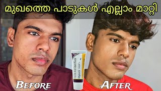 Glyco 6 Cream Review  ഒരു മാസത്തെ എന്റെ അനുഭവം [upl. by Ramunni]