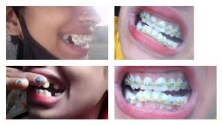 Mybraces journey  bracesexperience videos before and after pic👍😔पूराvideoजरुऱ देख़ना [upl. by Lindholm]