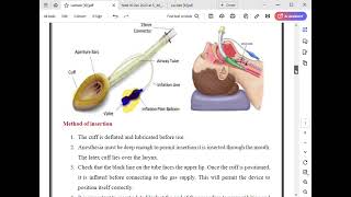 Lecture 10 supraglottic airway devices [upl. by Burnham]