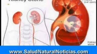 Terapia de quelación con EDTA y desintoxicación de metales pesados utilizado en la parte 3 [upl. by Kelton742]