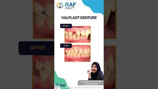 VALPLAST DENTURE dentist doktergigimalang dentalclinic doktergigimalangraya [upl. by Louie]