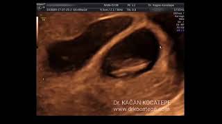 How is an 8 weeks dichorionic diamniotic twin pregnancy seen on ultrasound Possible lambda sign [upl. by Ninehc]