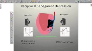 Localizing Ischemia on the ECG [upl. by Carpio472]