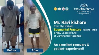 Segmental Fracture Patient Finds a New Lease of Life at Continental Hospitals  Dr Gowtham Chowdary [upl. by Etnoel]