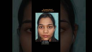 RHINOPLASTY SURGERY HYDERABAD BANGALORE VISAKHAPATNAM WARANGAL GUNTUR KHAMMAM TIRUPATI KARIMNAGAR [upl. by Gayle743]