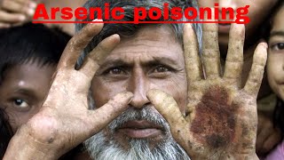 arsenic poisoning management in bangla  drarmin anwar [upl. by Lolanthe]