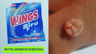 CARA MENGHILANGKAN KUTIL DI TANGAN DENGAN CEPAT  SEHAT TUBE [upl. by Alial705]