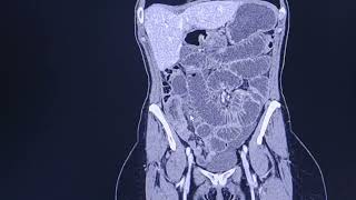 Small bowel intussusception causing small bowel obstruction  CT findings [upl. by Etnauq]