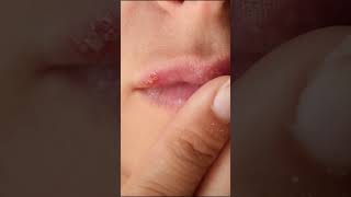 Passe Própolis nas Feridas de Herpes Resultado Excelente Ação Antiviral propolis própolis [upl. by Antonella116]