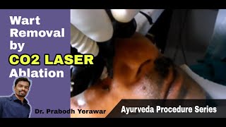 Wart removal by CO2 LASER  Procedure Series [upl. by Nommad]