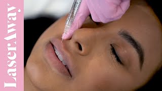 Lips By LaserAway  Juvederm  Ask Dr Kirby [upl. by Gagliano]