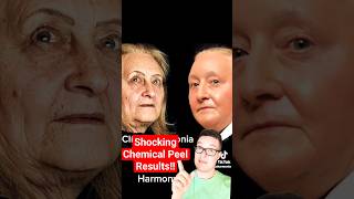 SHOCKING CHEMICAL PEEL BEFORE AND AFTER  Phenol Peel shorts [upl. by Oirevas346]