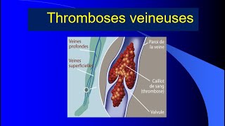 La thrombose veineuse profonde Pr Djellaoudji [upl. by Miguela]