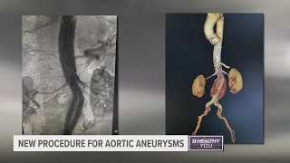 West Michigan man has new procedure to treat aortic aneurysm first in state [upl. by Nnylidnarb742]